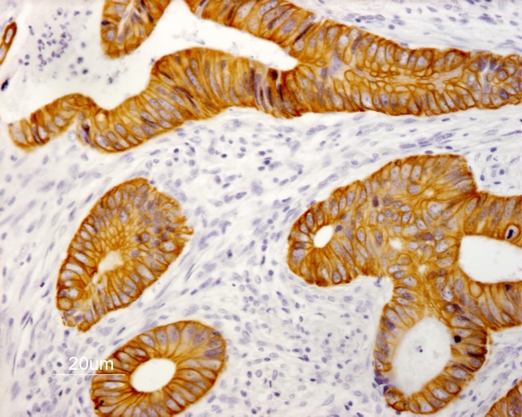 Figure 7. Indirect immunoperoxidase staining of human colon adenocarcinoma paraffin tissue section with MUB0329P (RCK108; Mouse anti keratin 19). Dilution 1:50 and microwave pretreatment. Specific staining of the epithelial tumor cells. No reactivity in connective tissues.